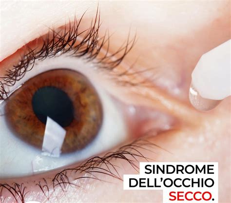 Sindrome Dell Occhio Secco Studio Oculistico Dott Francesco Sbano