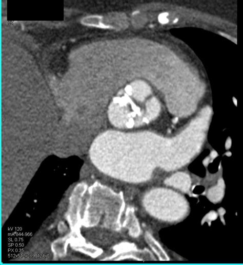 Aortic Valve Calcification And Stenosis Cardiac Case Studies Ctisus