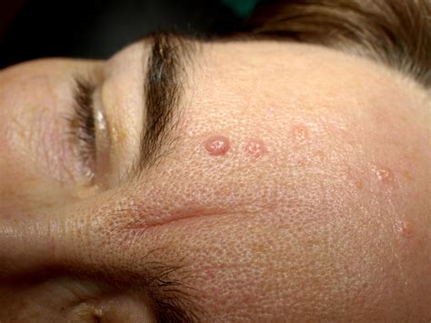 Seborrhoeic Keratosis Is A Common Harmless Skin Growth It Can Also Be