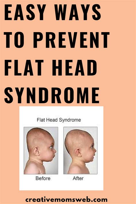 How To Prevent Baby Flat Head Syndrome Flat Head Syndrome Flat Head