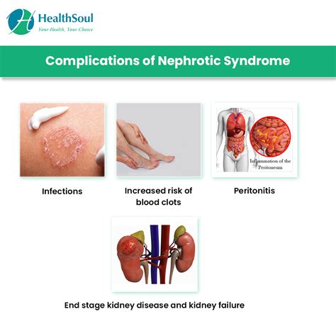 Pathophysiology Of Nephrotic Syndrome Nephrotic Syndrome