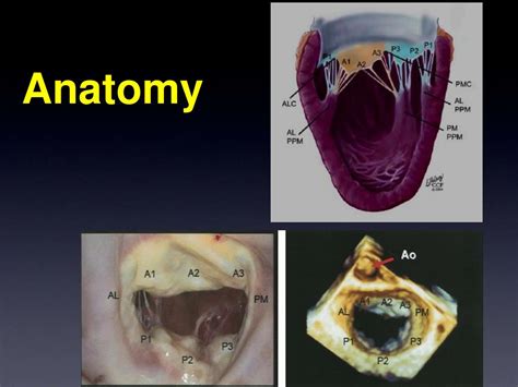 Ppt Percutaneous Mitral Valve Repair Using The Mitraclip® Device E