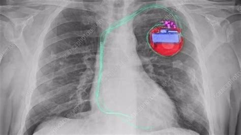 Pacemaker X Ray Stock Video Clip K0051036 Science Photo Library
