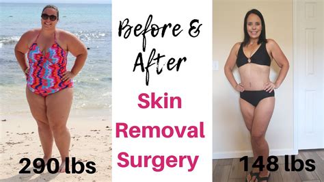 Before After Skin Removal Surgery After Vsg Gastric Sleeve Surgery