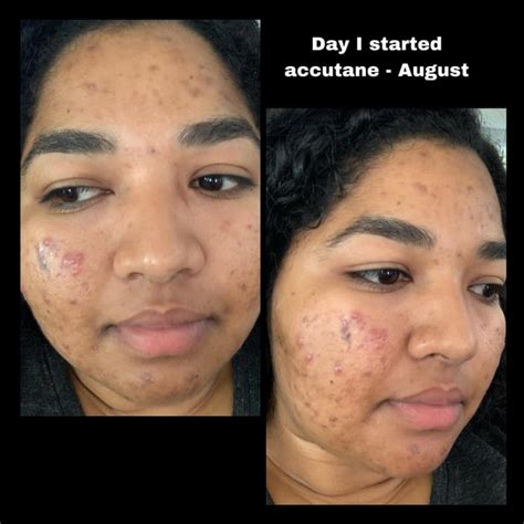 My Accutane Journey Before And Current Pictures Side Effects And