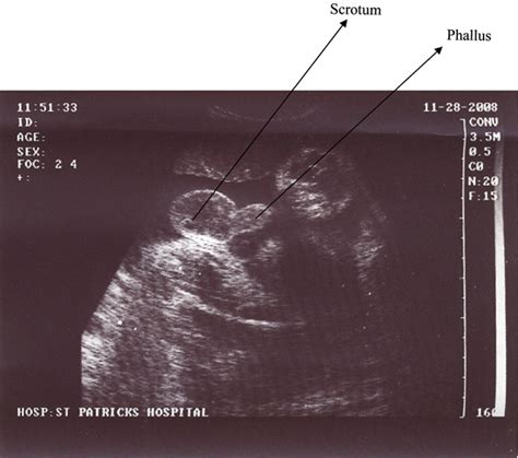 Figure 1 From Sonographic Determination Of Fetal Gender In The Second And Third Trimesters In A