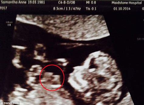 Unborn Baby Whose Heart Is Growing Outside His Body Due To Ectopia