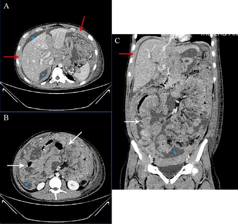 Frontiers Non Hodgkins Lymphoma Presenting As Isolated Peritoneal
