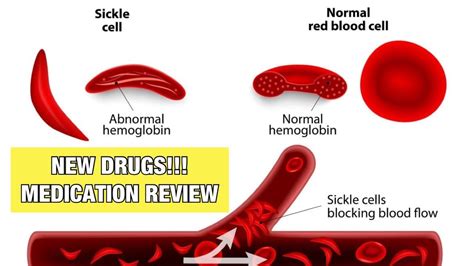 2 New Sickle Cell Disease Drugs Medication Review Youtube