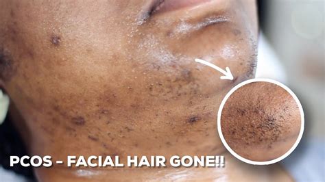 Another possibility is that just like long black hair that grows on the face and neck, these white hairs are also random (genetically mutant) hair that grow during times of hormonal fluctuation in. HOW TO WAX YOUR CHIN HAIR AT HOME | DIY Sugar Wax Hair ...
