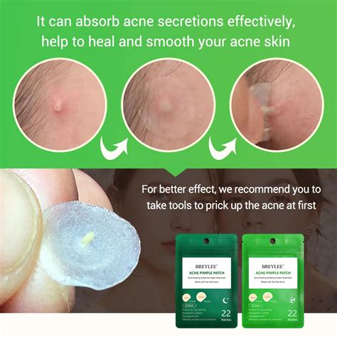 Acne Pimple Patch Remover Blackhead Blemish Treatment Sticker