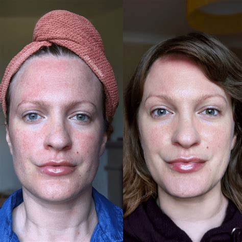 Dermatica Rosacea Treatment 3 Month Results 6 Month Update