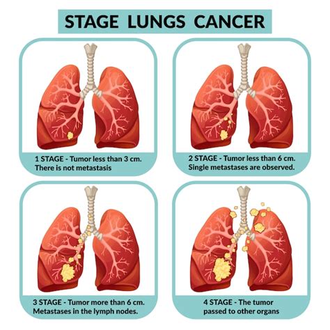 Premium Vector Stages Of Lungs Cancer