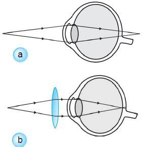 Bagian Bagian Mata Sebagai Alat Optik Serta Macam Macam Jenis Penyakit