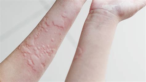 Itchy Bumps On Skin Like Mosquito Bites Seeds Yonsei Ac Kr The Best
