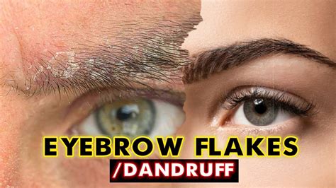 How To Get Rid Of Eyebrow Dandruff In Juat A Week Best Home Remedies