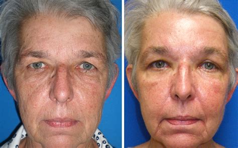Active Fx Resurfacing Richmond Va Cosmetic Facial Surgery