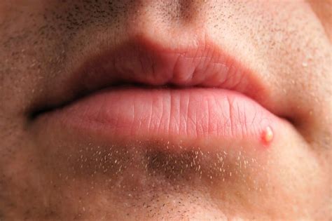 The 13 Causes Of Swollen Lips You Should Definetly Be Aware Of Optinghealth