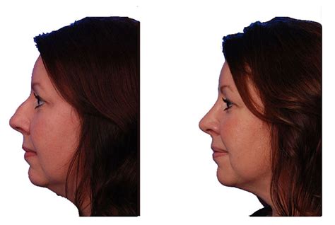 How To Remove A Dorsal Hump Nose Bump — Sky Facial Plastic Surgery
