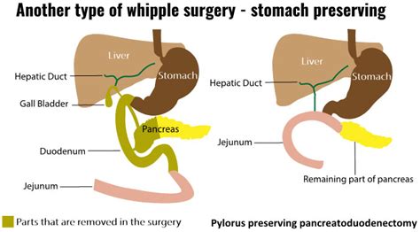 Pancreaticoduodenectomy Whipple Procedure
