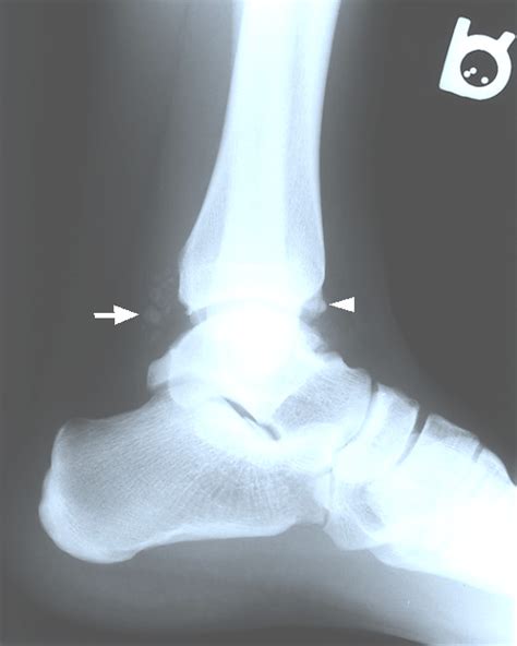 Lateral Right Ankle Radiograph With Evidence Of Calcified Loose Bodies