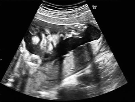 D Ultrasound Showing 16 Weeks Fetus With Cleft Palate Download