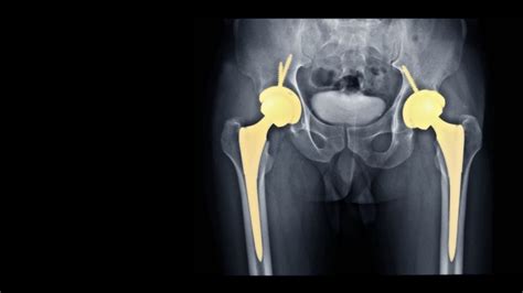 Total Hip Replacement Thr Kmh Health Blog