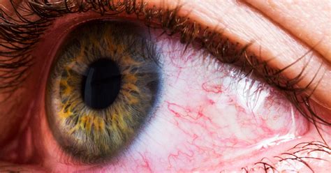 Lupus And Dry Eyes Causes Diagnosis And Treatment