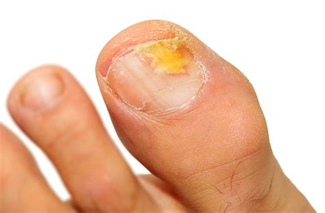 Fungal Toenails And Onychomycosis The Foot And Ankle Clinic