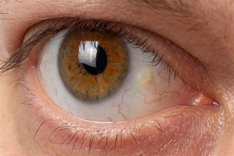 Pinguecula Yellow Bump On Eyeball Diagnosis Causes And Treatment