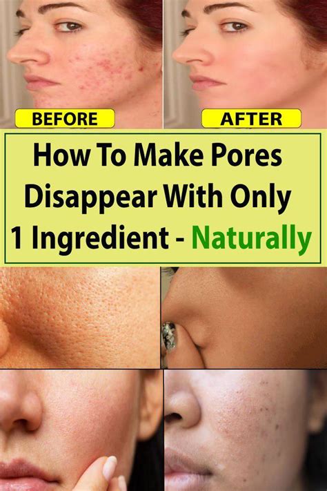 How To Make Pores Disappear With Only 1 Ingredient Naturally Healthy