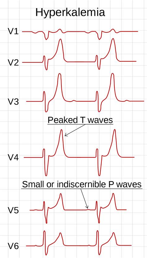 Hyperkalemia Causes Signs Symptoms Ecg Changes And