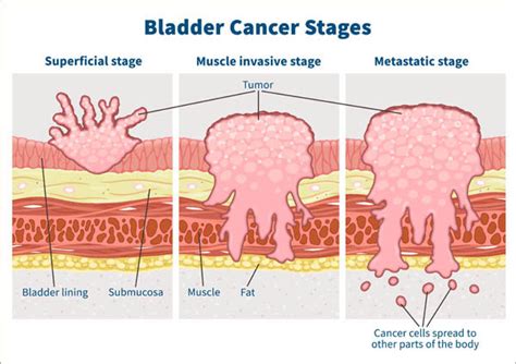 What Are The Types Of Bladder Cancer Updated