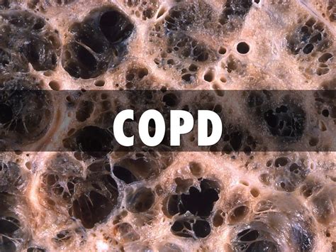 Copd By Kim Delafuente