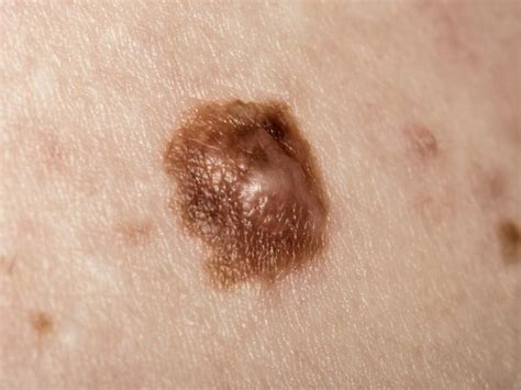 What Does Stage Skin Cancer Look Like CancerWalls