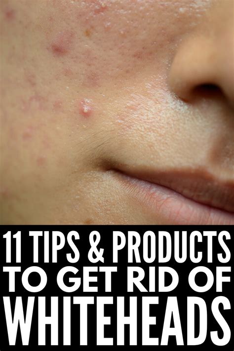 How To Get Rid Of Clogged Pores 11 Remedies And Products We Swear By In
