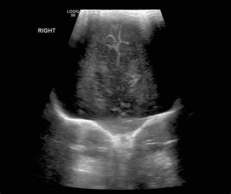 Grade Iv Germinal Matrix Hemorrhage With Periventricular Leukomalacia