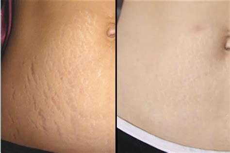 New Treatments For Stretch Marks