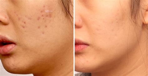 Acne Scars Airgent20