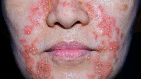 Eczema In Pictures Everyday Health