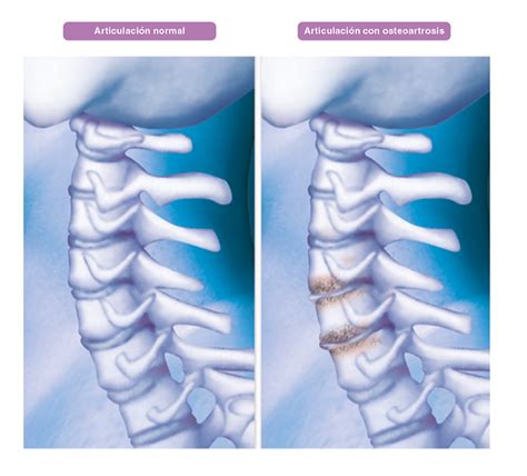 Osteoartrosis En Columna Vertebral Dr Alberto Marqués