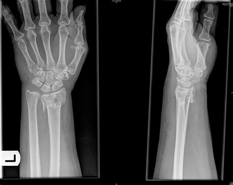 Distal Radial Fracture 409
