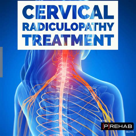 What Is The Cervical Radiculopathy Images And Photos Finder