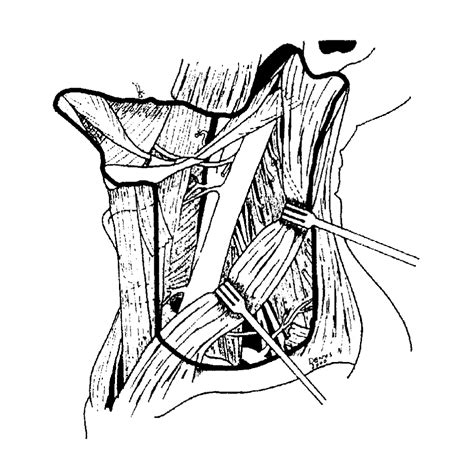 Neck Dissection Classification Update Oncology Jama Otolaryngology