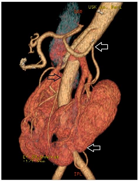 Horseshoe Kidney Supplied By Supernumerary Arteries The First