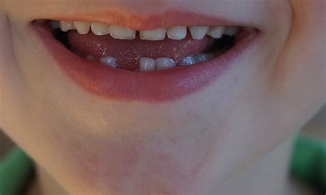 We did not find results for: The Best (Dentist-Approved!) Ways to Remove Your Child's ...