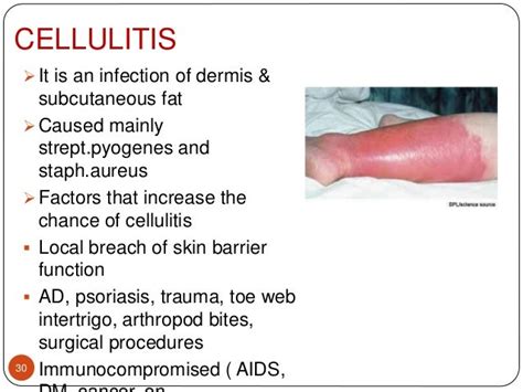 Staphylococcal Infections As Related To Cellulitis Pictures