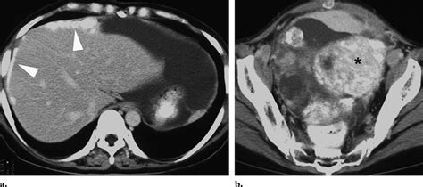 Peritoneal Carcinomatosis Secondary To Serous Cystadenocarcinoma Of