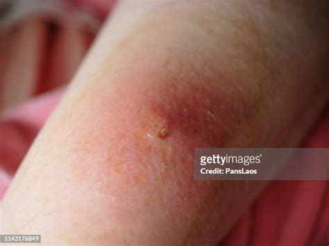 Eczema Blisters Photos And Premium High Res Pictures Getty Images