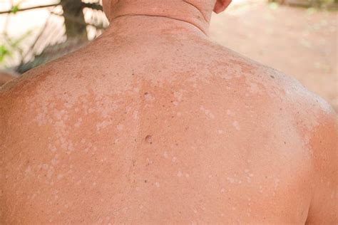 Tinea Versicolor White Spots On Skin